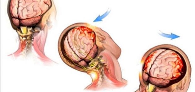 ما ‫أعراض ارتجاج المخ؟