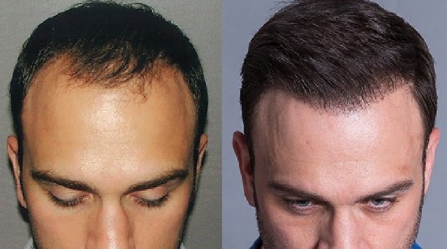 معلومات مهمة عن عملية زراعة الشعر